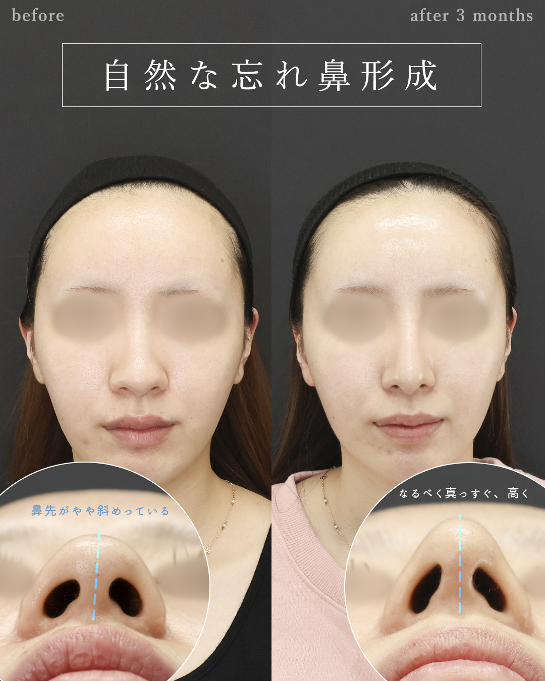 鼻尖形成・鼻尖縮小/鼻先軟骨移植/隆鼻術（プロテーゼ・自家組織）の症例写真 施術前後 
