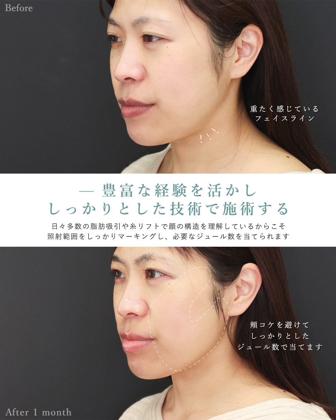 オンダリフト（オンダプロ）・オンダリフトボディの症例写真 施術前後 
