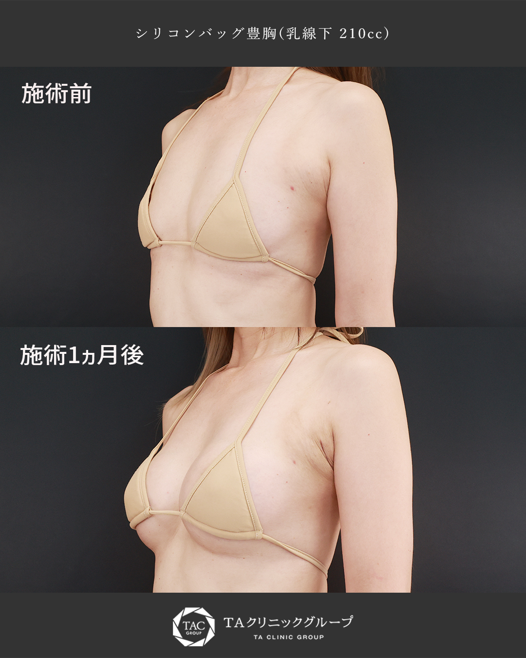 自然さにこだわったシリコンバッグ豊胸│40代