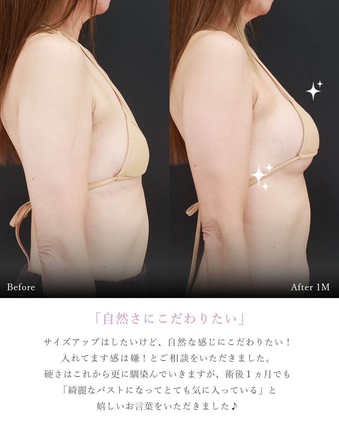 シリコンバッグ豊胸（人工乳腺バッグ）の症例写真 施術前後 