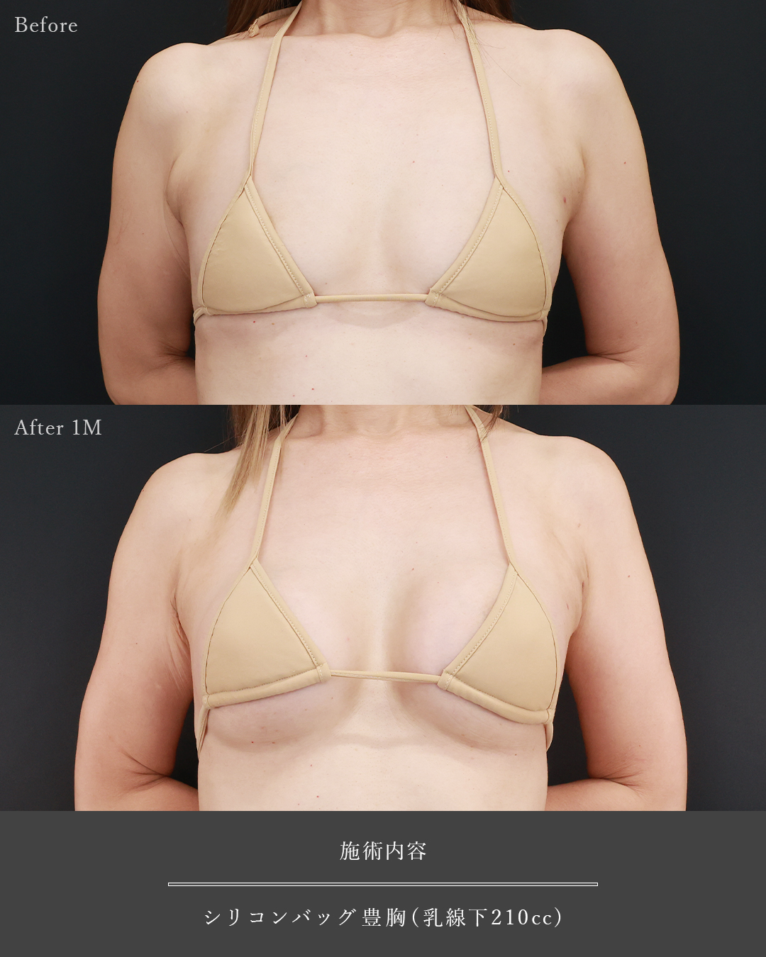 シリコンバッグ豊胸（人工乳腺バッグ）の症例写真 施術前後 