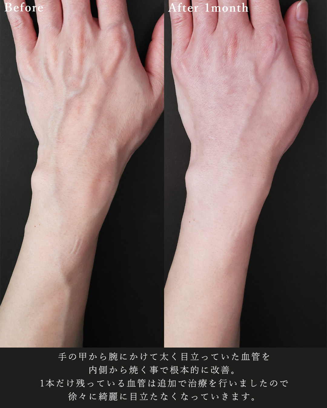ハンドベイン（手のアンチエイジング・血管治療）の症例写真 施術前後 