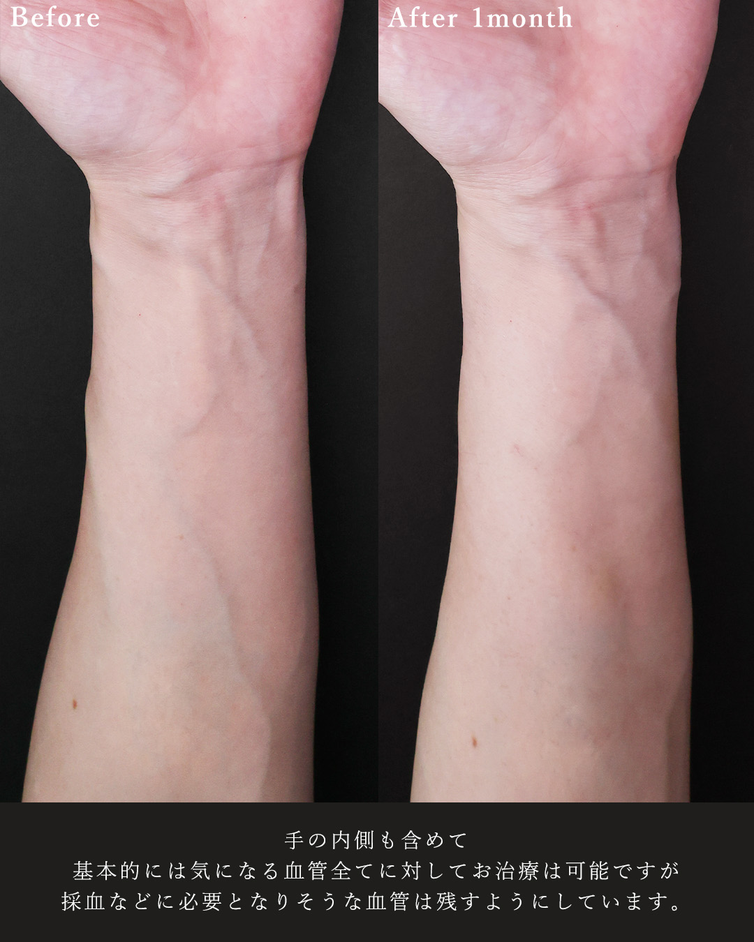 ハンドベイン（手のアンチエイジング・血管治療）の症例写真 施術前後 
