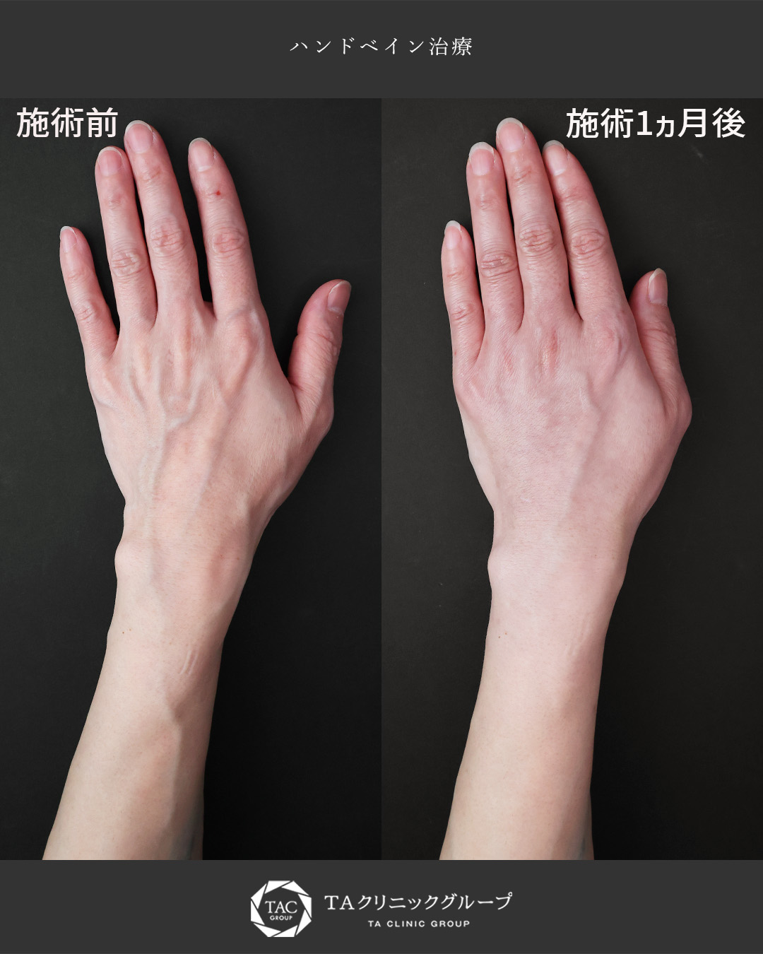 【手の血管治療】若々しく滑らかなお手元に