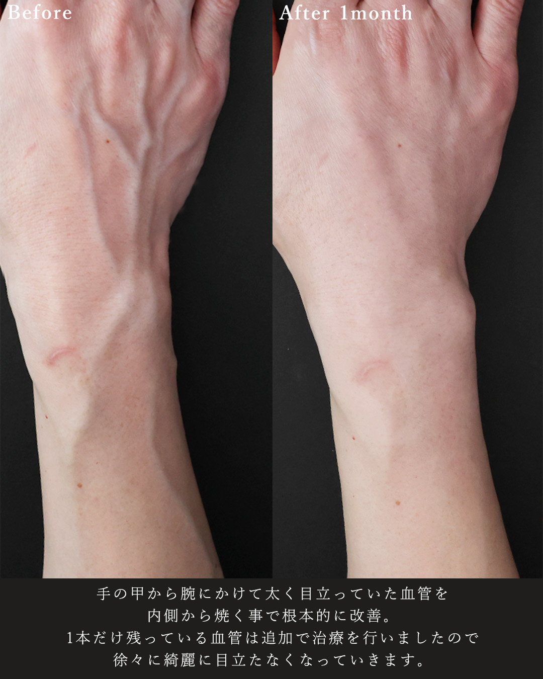 ハンドベイン（手のアンチエイジング・血管治療）の症例写真 施術前後 
