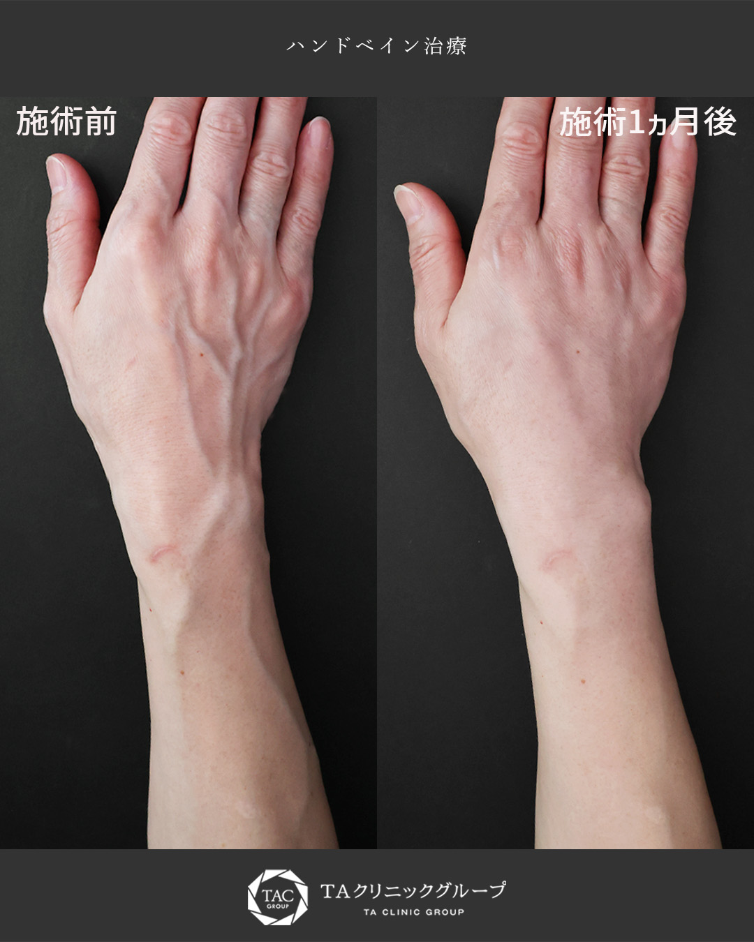 ハンドベイン（手のアンチエイジング・血管治療）の症例写真 施術前後 