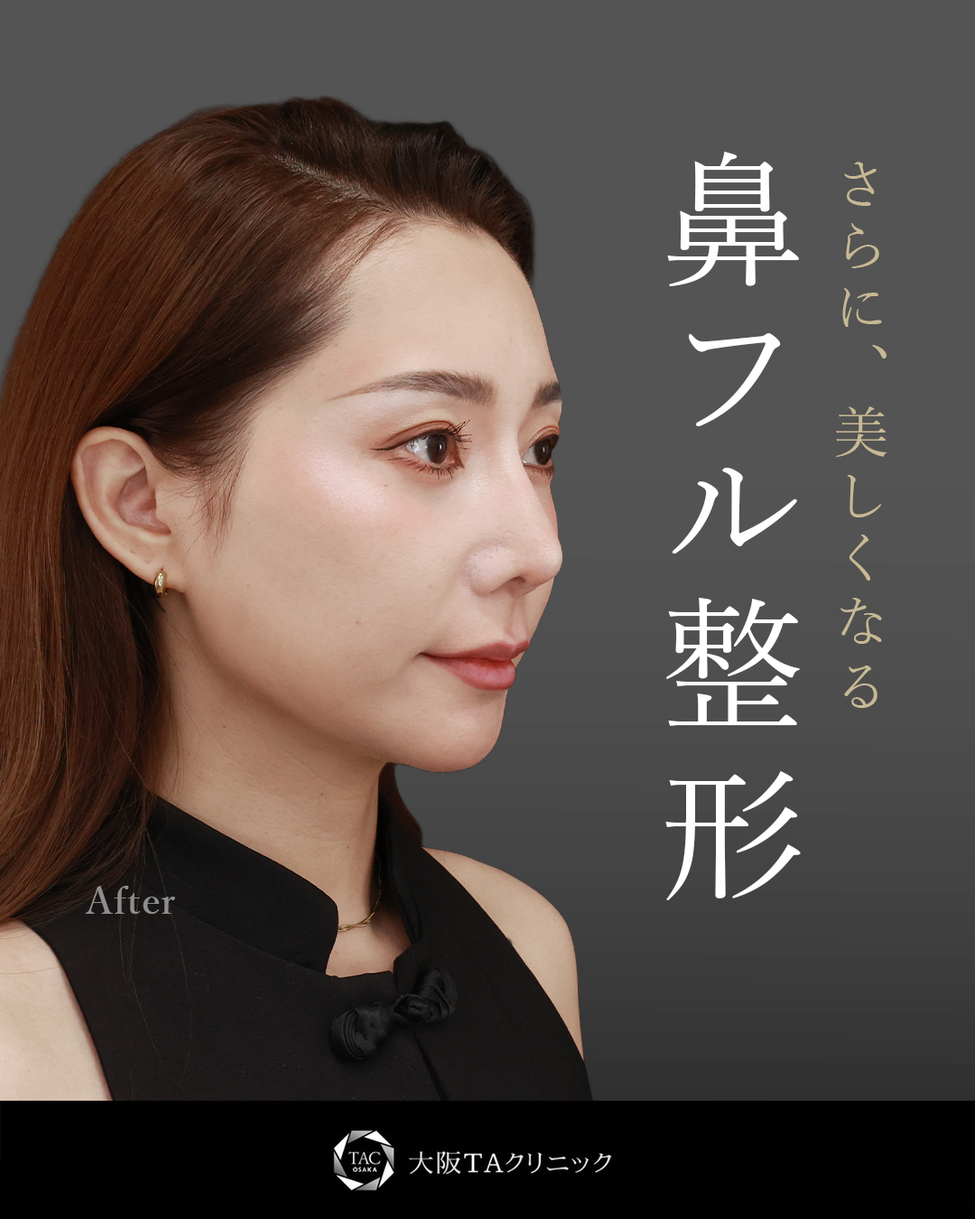 鼻中隔延長術/鼻尖形成・鼻尖縮小/隆鼻術（プロテーゼ・自家組織）の症例写真 施術前後 