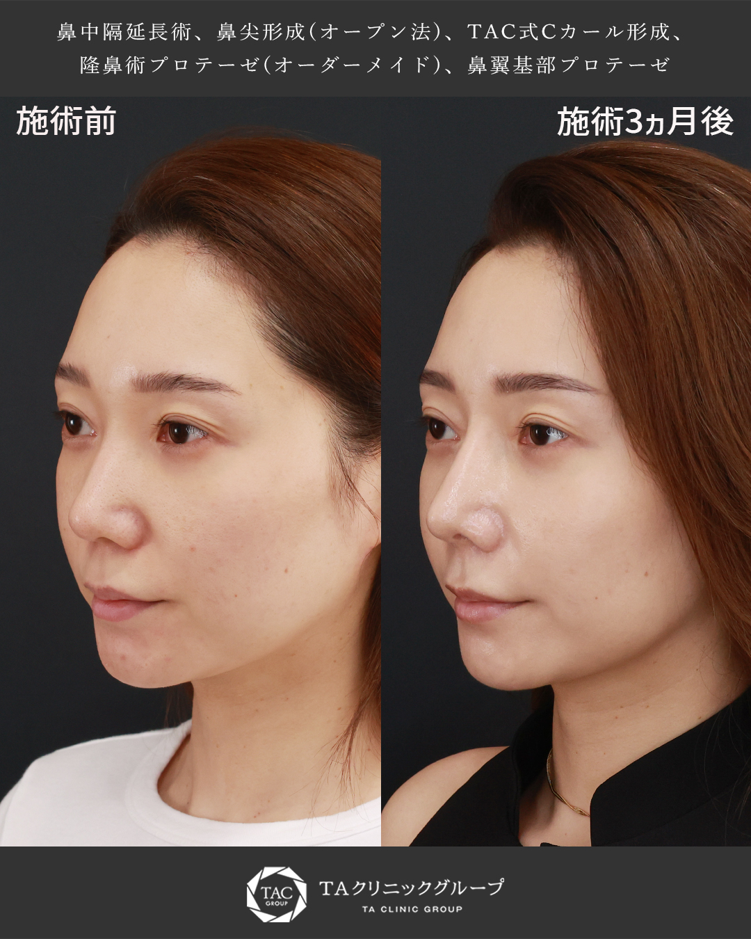 美女をさらにアップデート│鼻フル整形