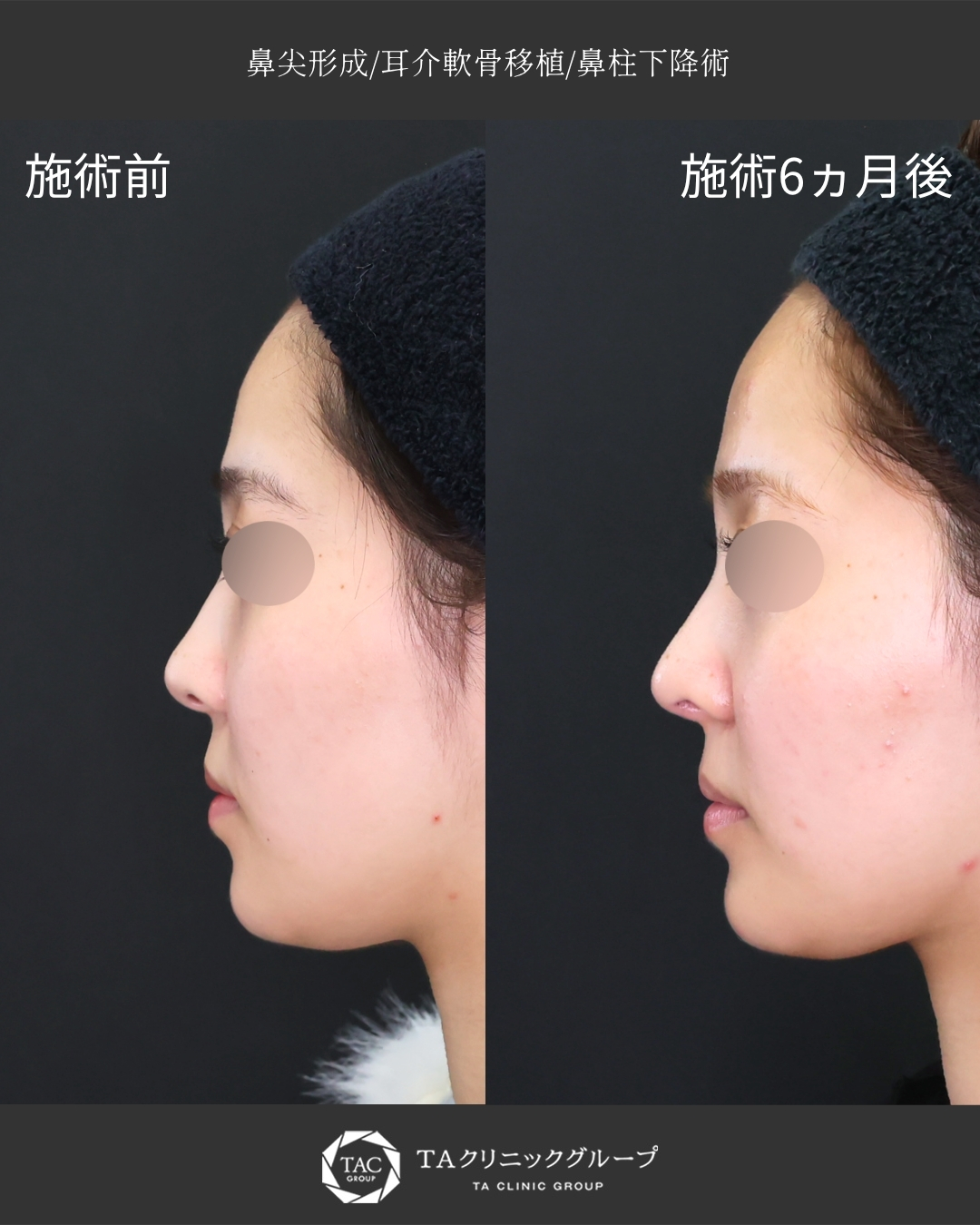【鼻整形】｜ナチュラルに鼻先とACRを整える◎