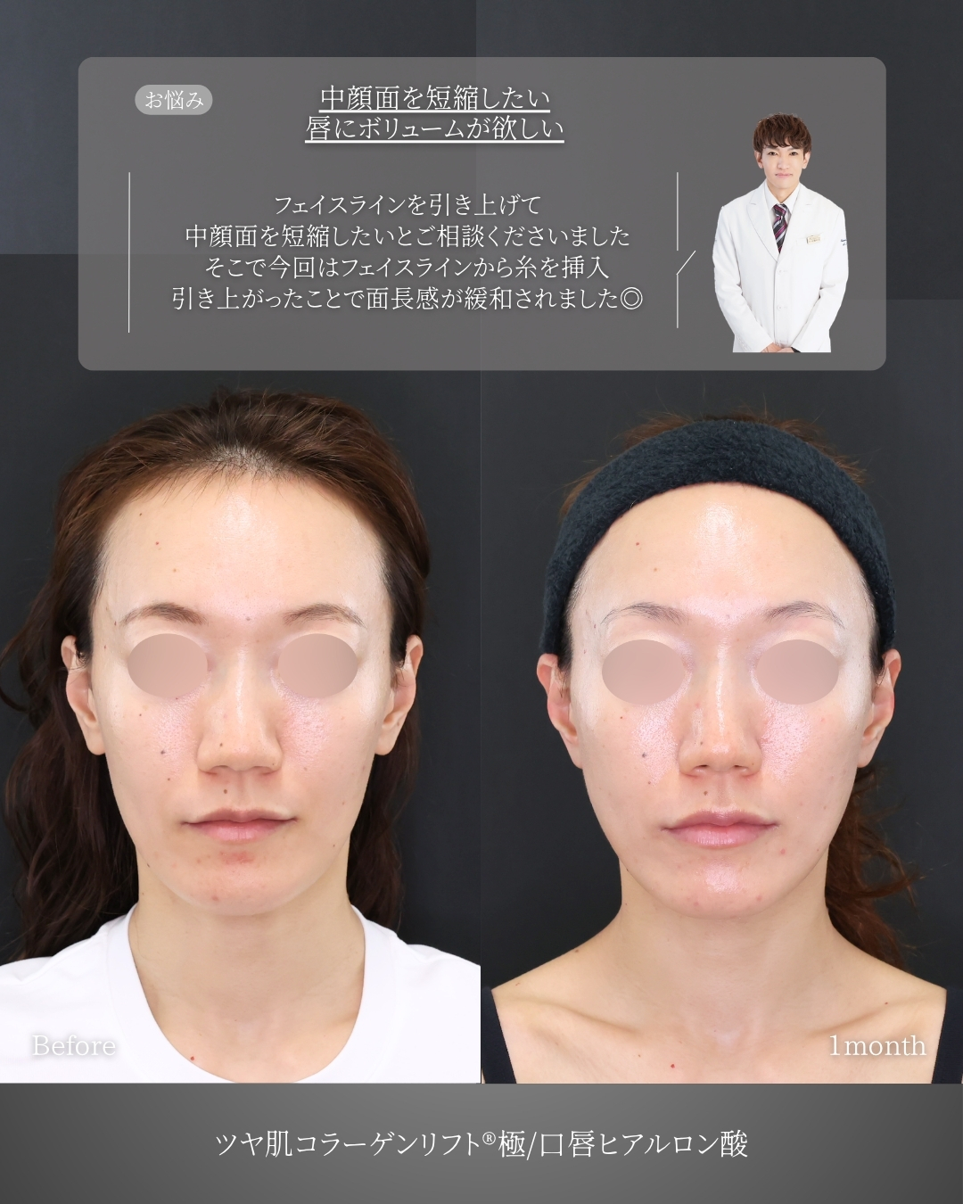 TAC式 ツヤ肌コラーゲンリフト®/ヒアルロン酸注射：その他の症例写真 施術前後 