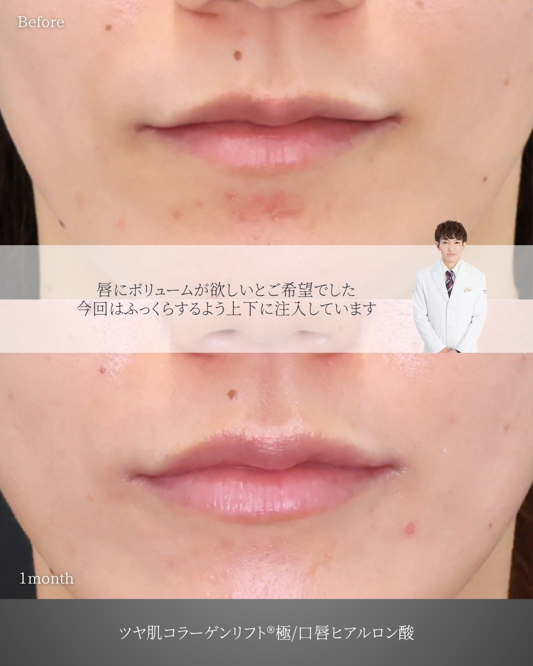 TAC式 ツヤ肌コラーゲンリフト®/ヒアルロン酸注射：その他の症例写真 施術前後 