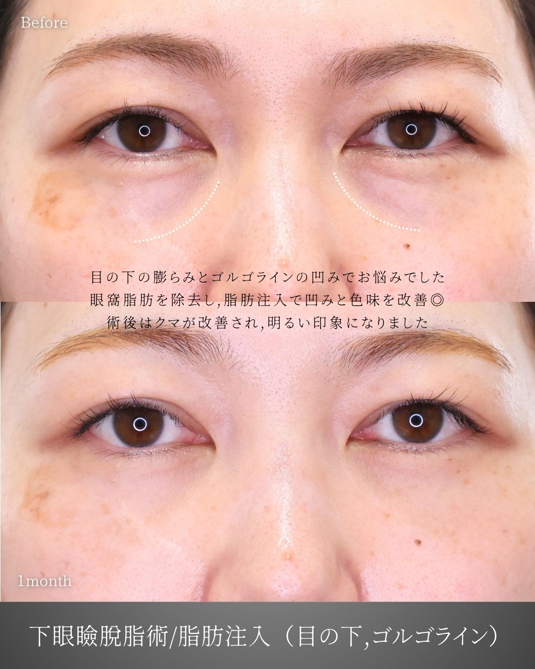 下眼瞼脱脂術（目の下のたるみ取り・目の下の脂肪ふくらみ取り）/顔の脂肪注入(コンデンスリッチフェイス)の症例写真 施術前後 