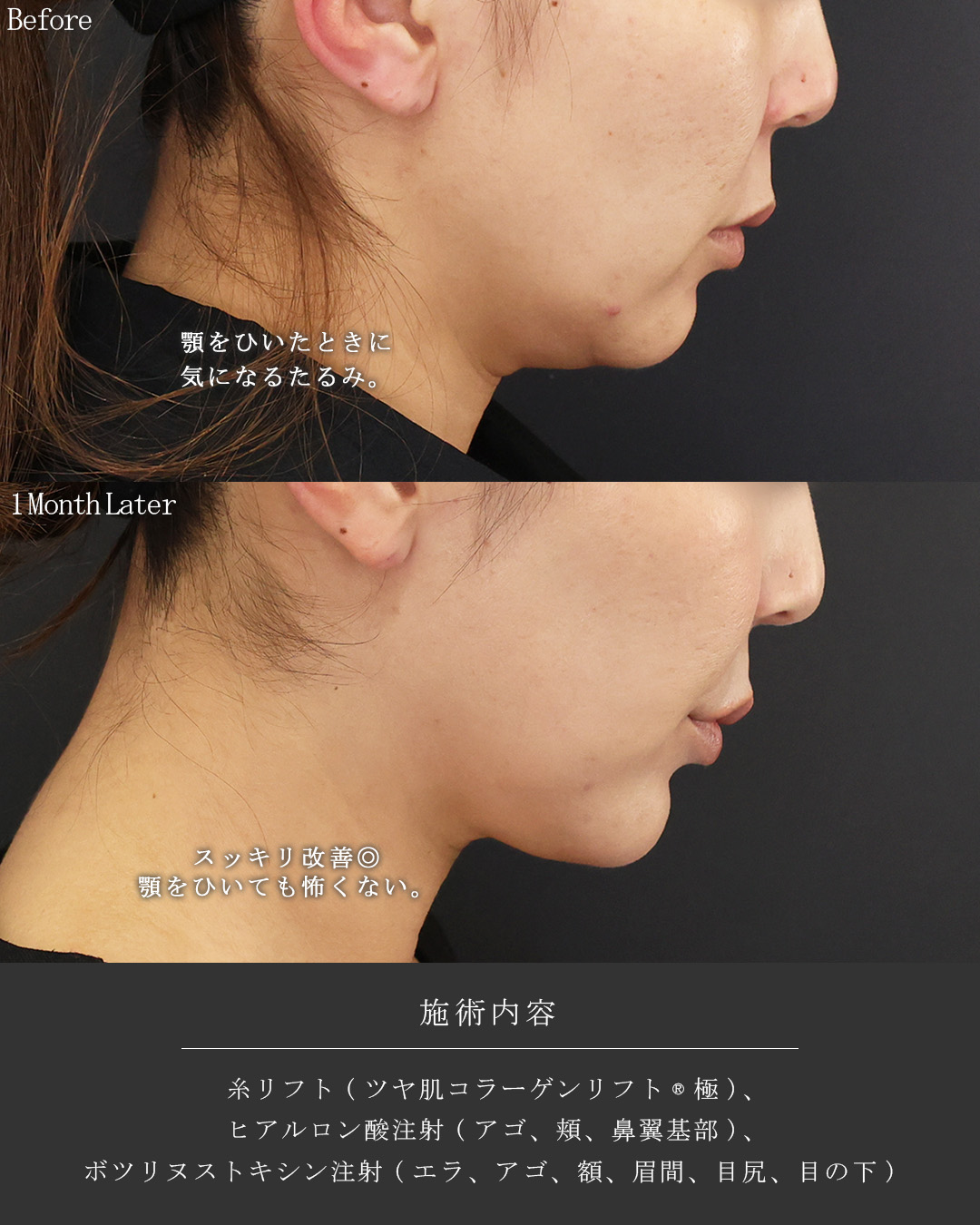 TAC式 ツヤ肌コラーゲンリフト®/ヒアルロン酸注射：その他の症例写真 施術前後 