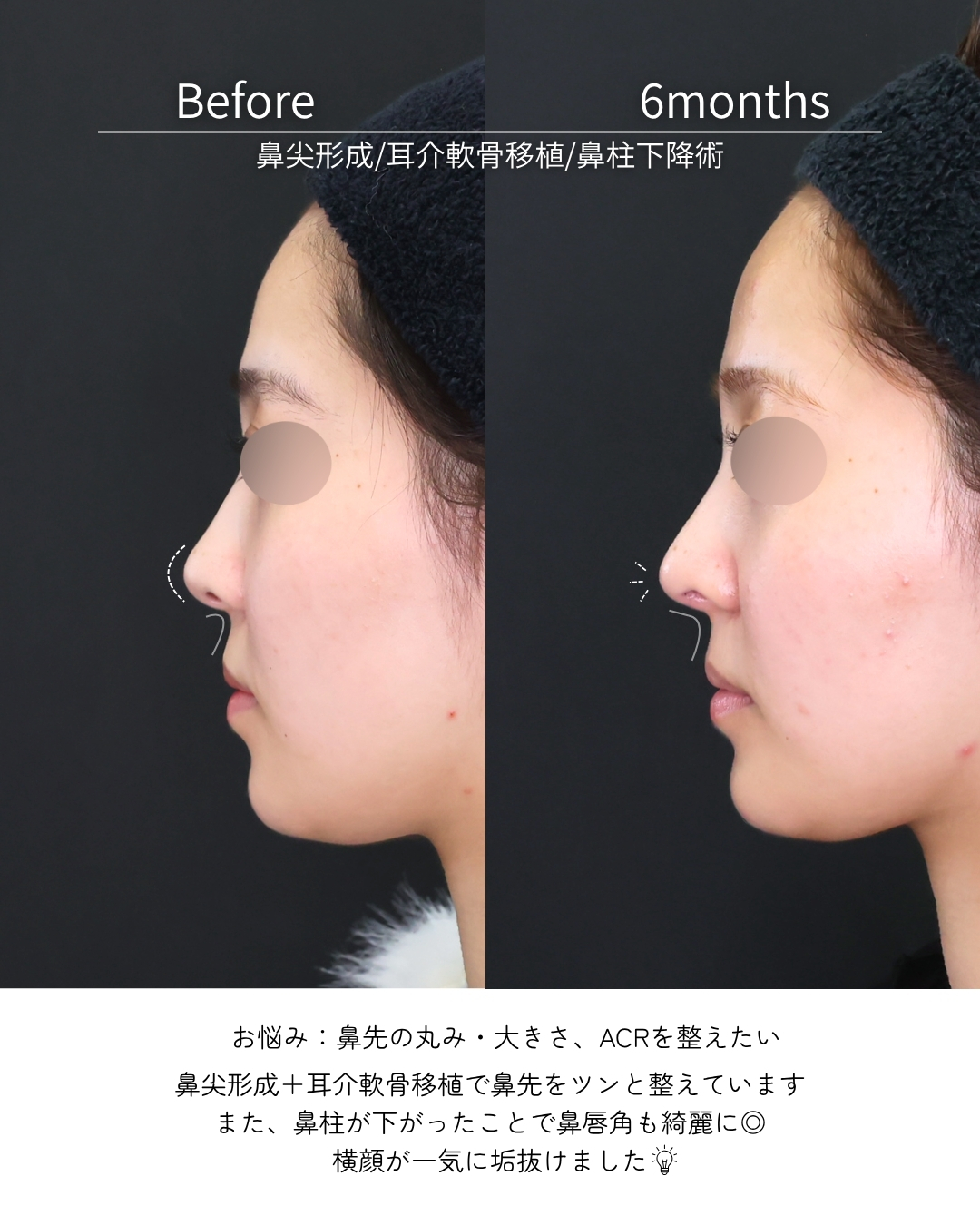 鼻尖形成・鼻尖縮小/鼻先軟骨移植/鼻唇角形成術・猫手術の症例写真 施術前後 