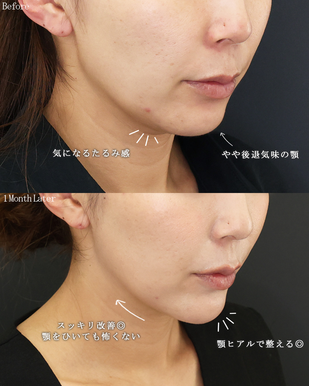 TAC式 ツヤ肌コラーゲンリフト®/ヒアルロン酸注射：その他の症例写真 施術前後 