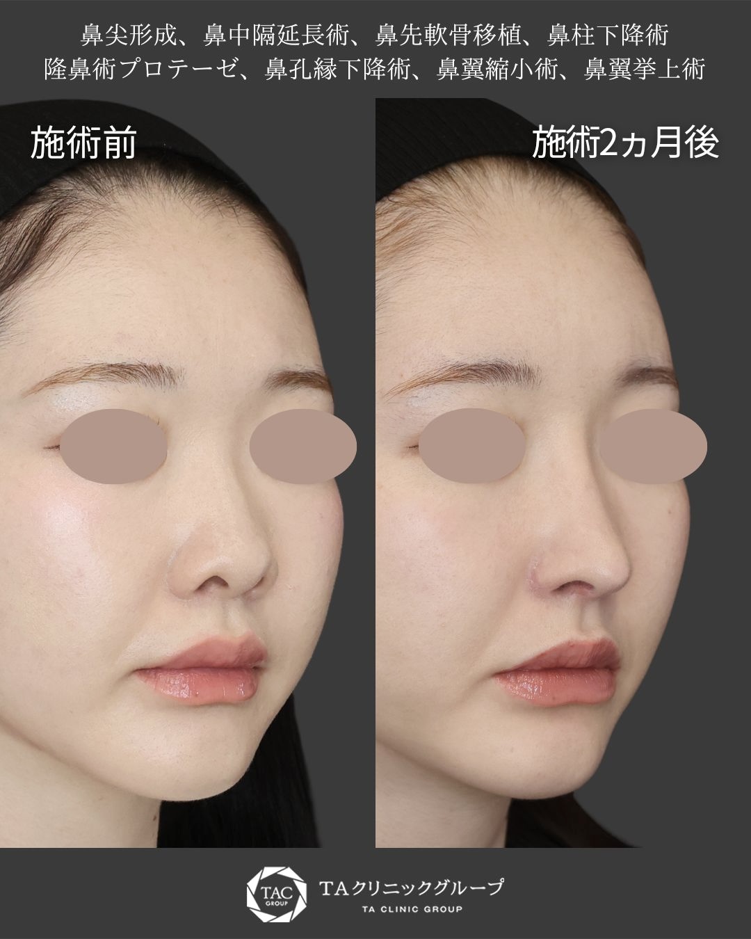 トータルデザインで叶える究極の忘れ鼻形成