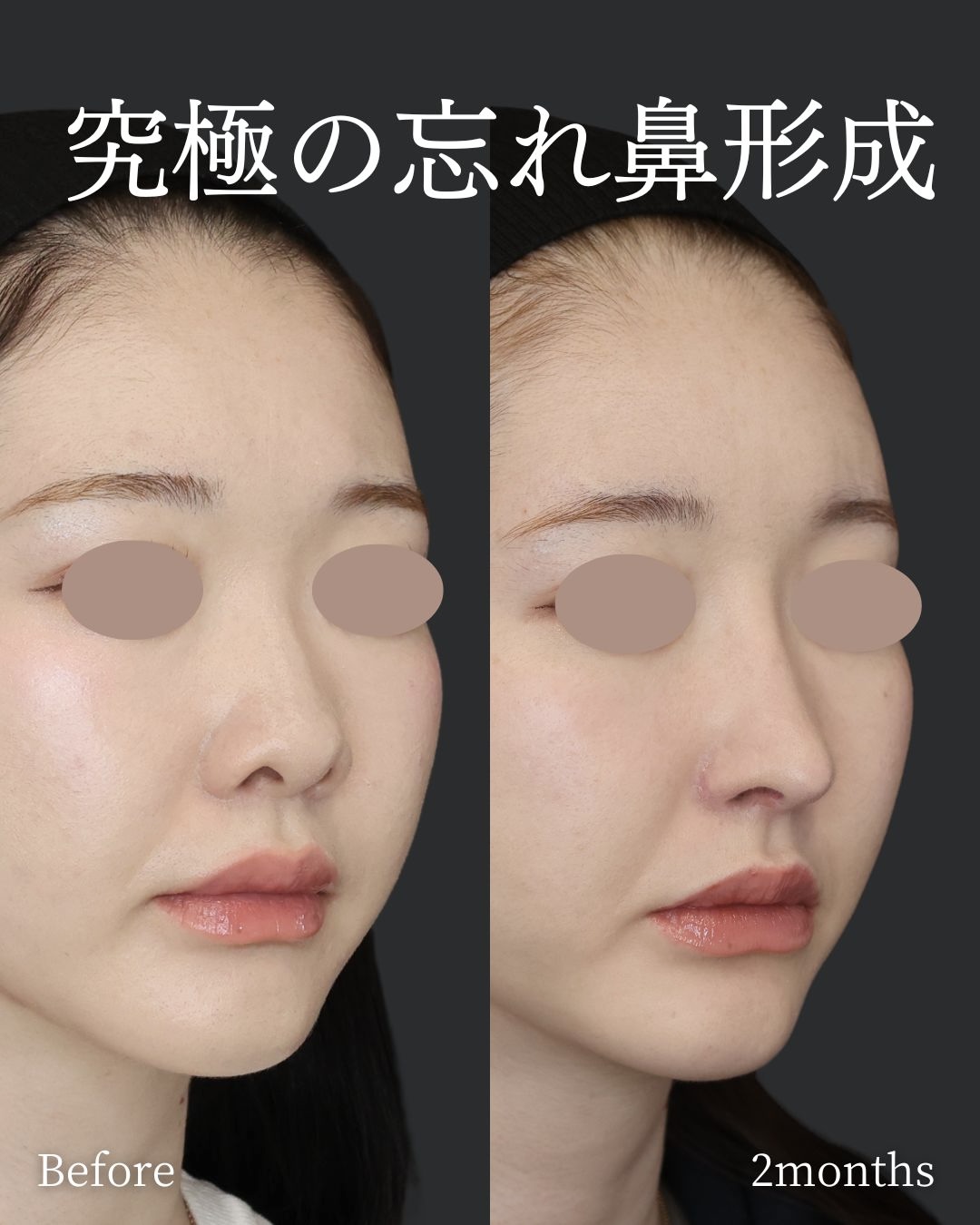 鼻尖形成・鼻尖縮小/鼻先軟骨移植/鼻翼挙上術の症例写真 施術前後 