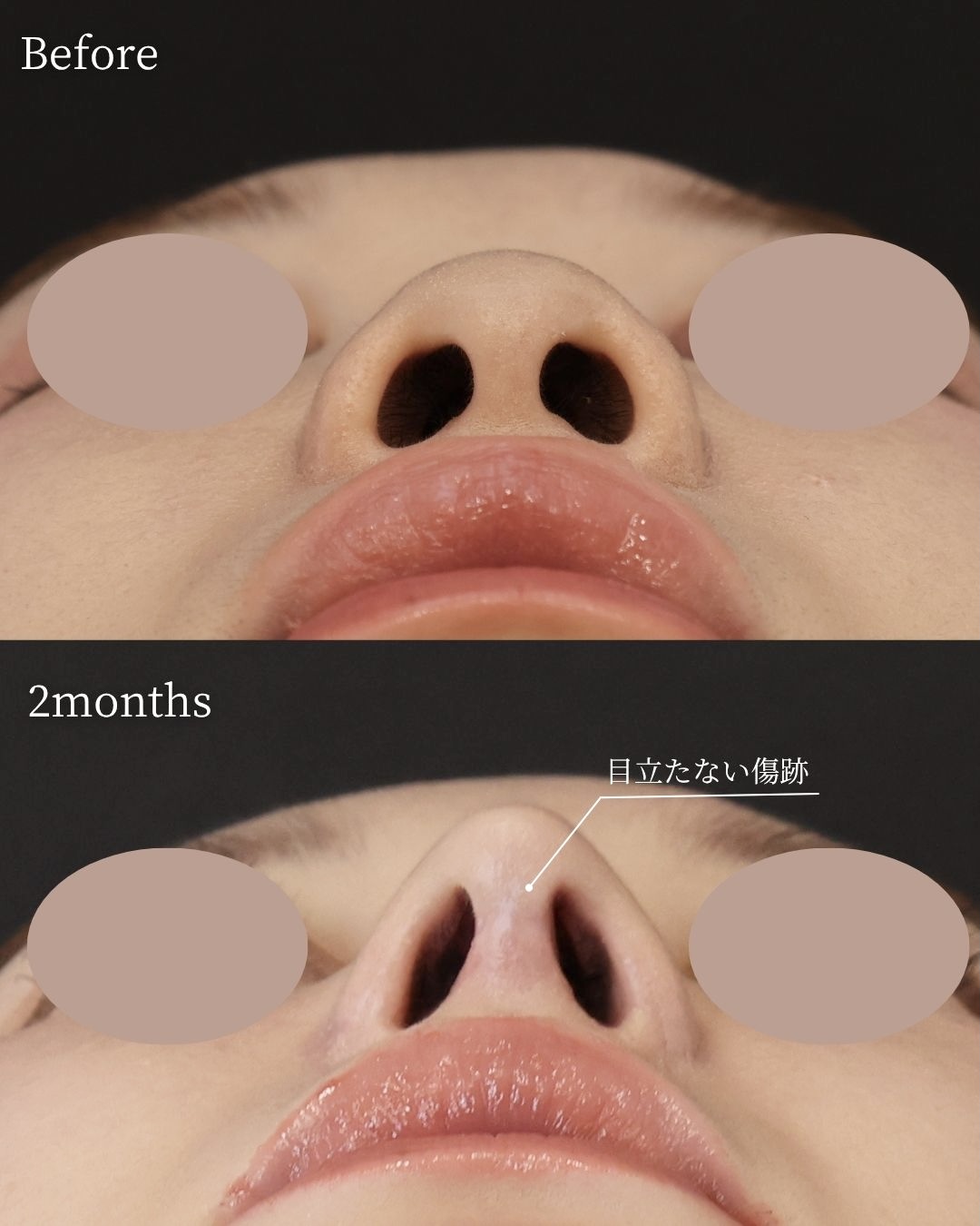 鼻尖形成・鼻尖縮小/鼻先軟骨移植/鼻翼挙上術の症例写真 施術前後 