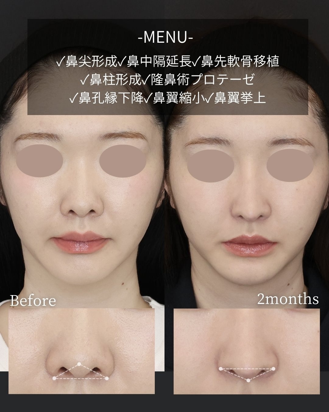 鼻尖形成・鼻尖縮小/鼻先軟骨移植/鼻翼挙上術の症例写真 施術前後 