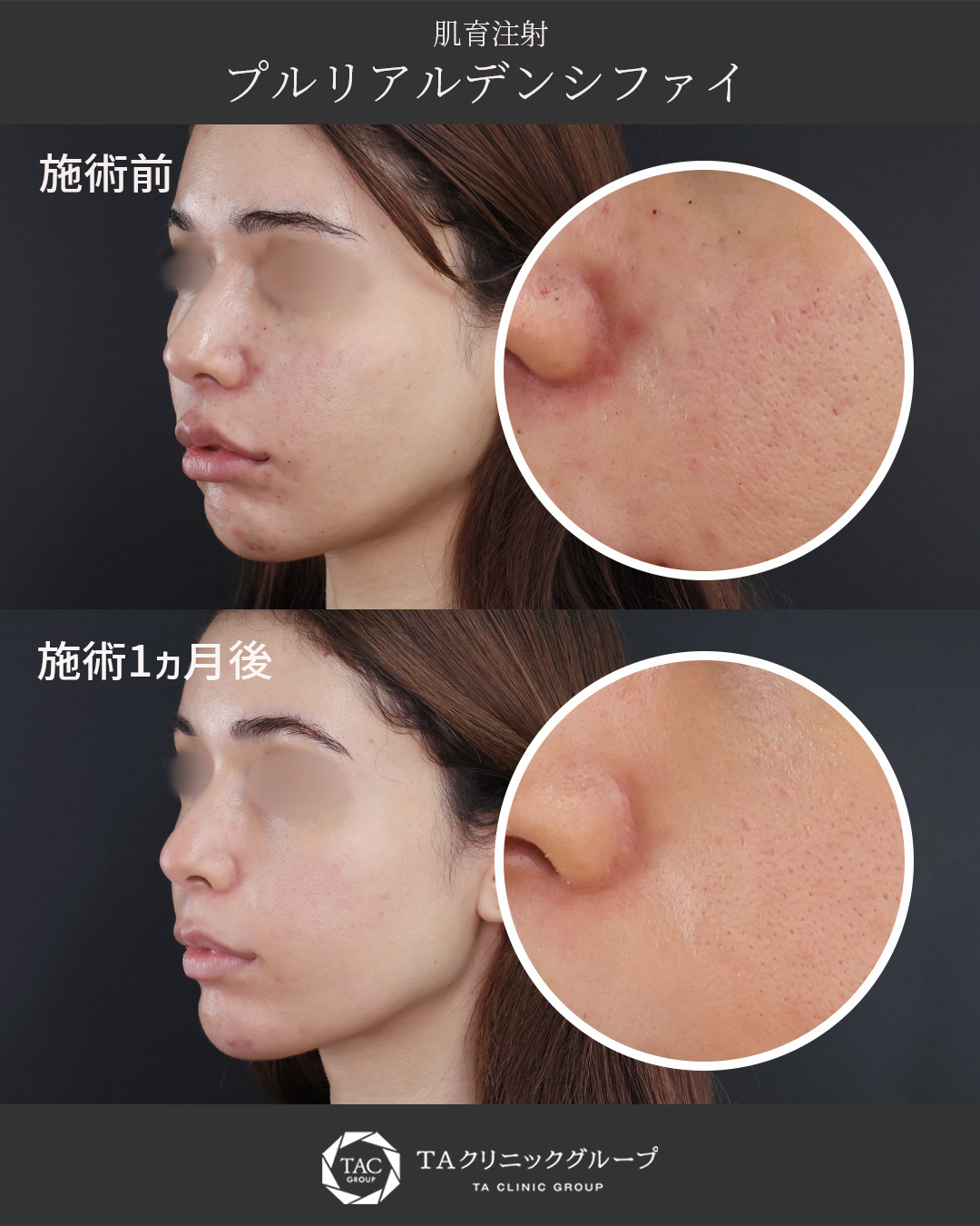 繰り返す肌荒れに、素肌力を底上げする肌育注射