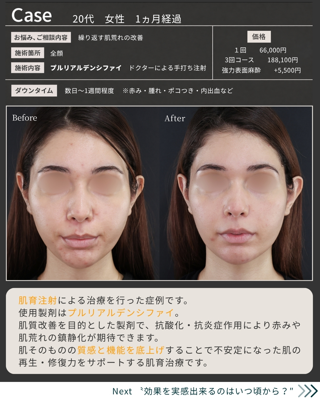 プルリアルデンシファイの症例写真 施術前後 
