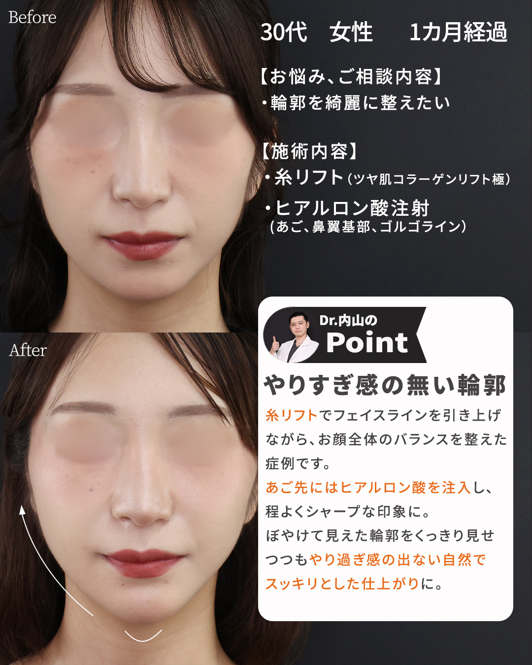 TAC式 ツヤ肌コラーゲンリフト®/ほうれい線のヒアルロン酸注射/顎のヒアルロン酸注射の症例写真 施術前後 