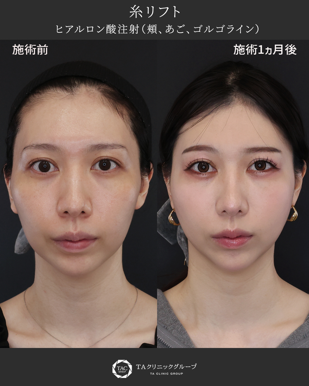 スッキリ整う若々しい輪郭へ