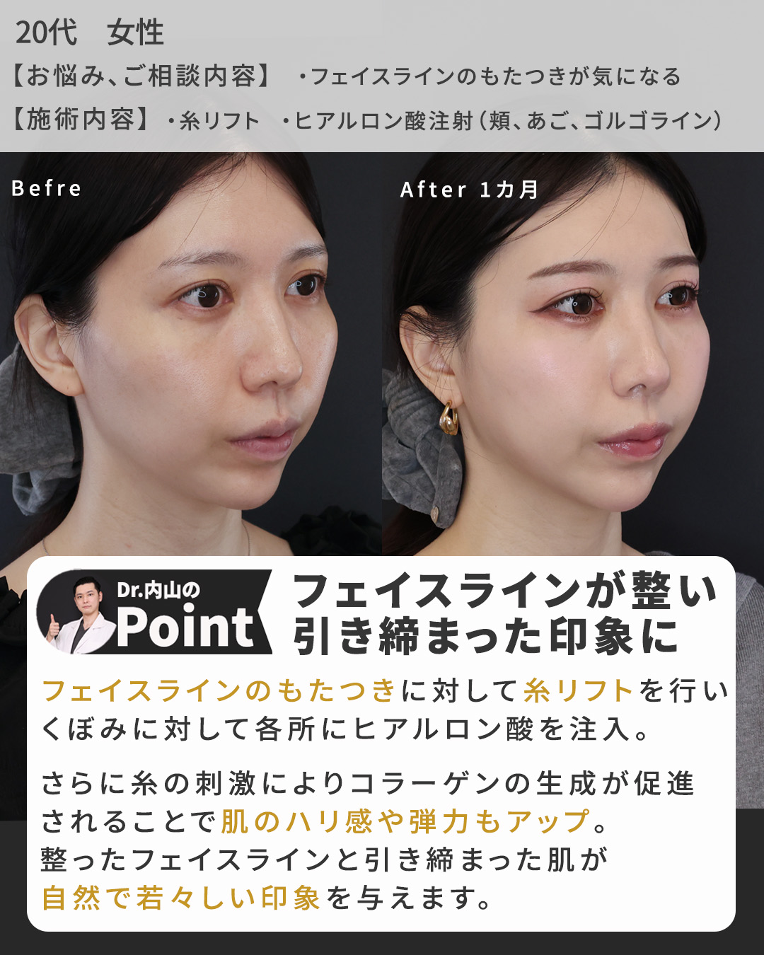 TAC式 ツヤ肌コラーゲンリフト®/ゴルゴ線のヒアルロン酸注射/顎のヒアルロン酸注射の症例写真 施術前後 