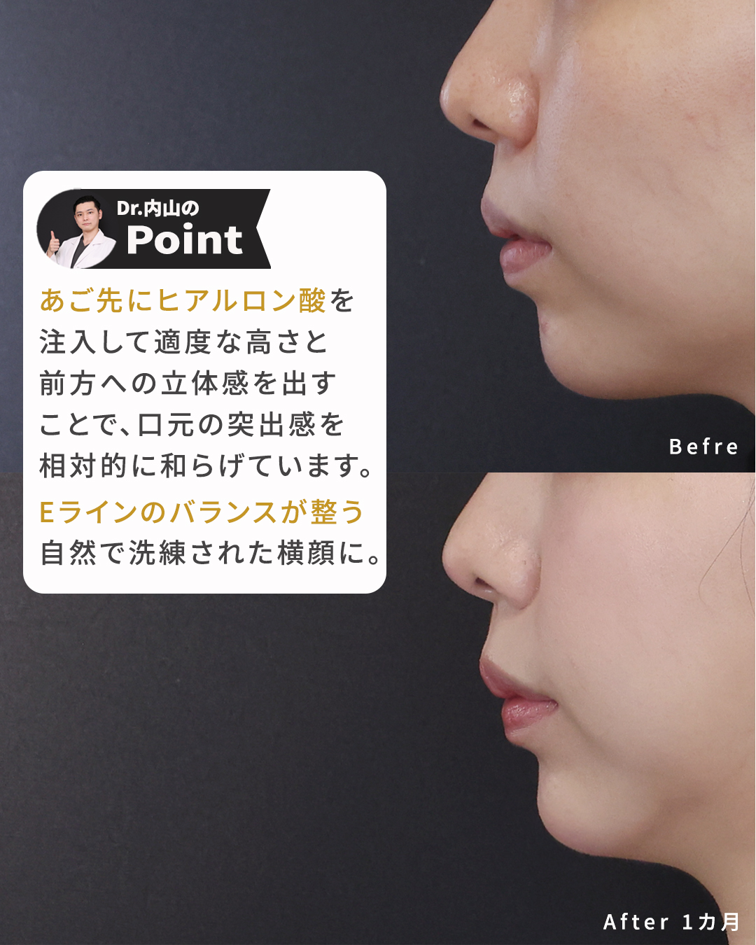 TAC式 ツヤ肌コラーゲンリフト®/ゴルゴ線のヒアルロン酸注射/顎のヒアルロン酸注射の症例写真 施術前後 