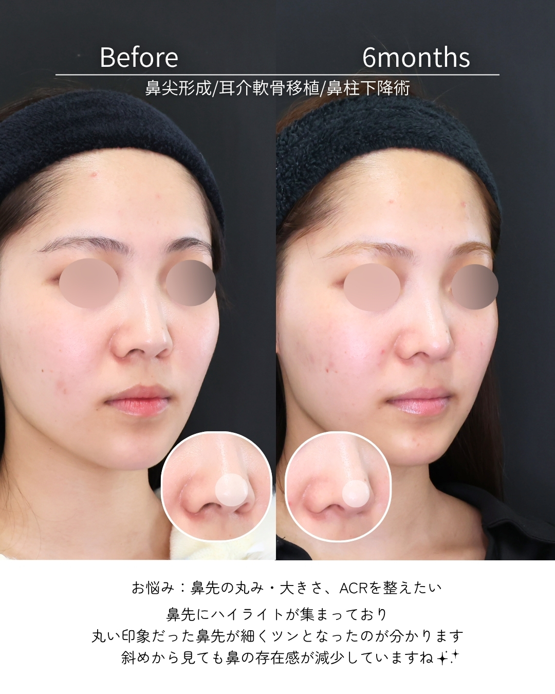 鼻尖形成・鼻尖縮小/鼻先軟骨移植/鼻唇角形成術・猫手術の症例写真 施術前後 
