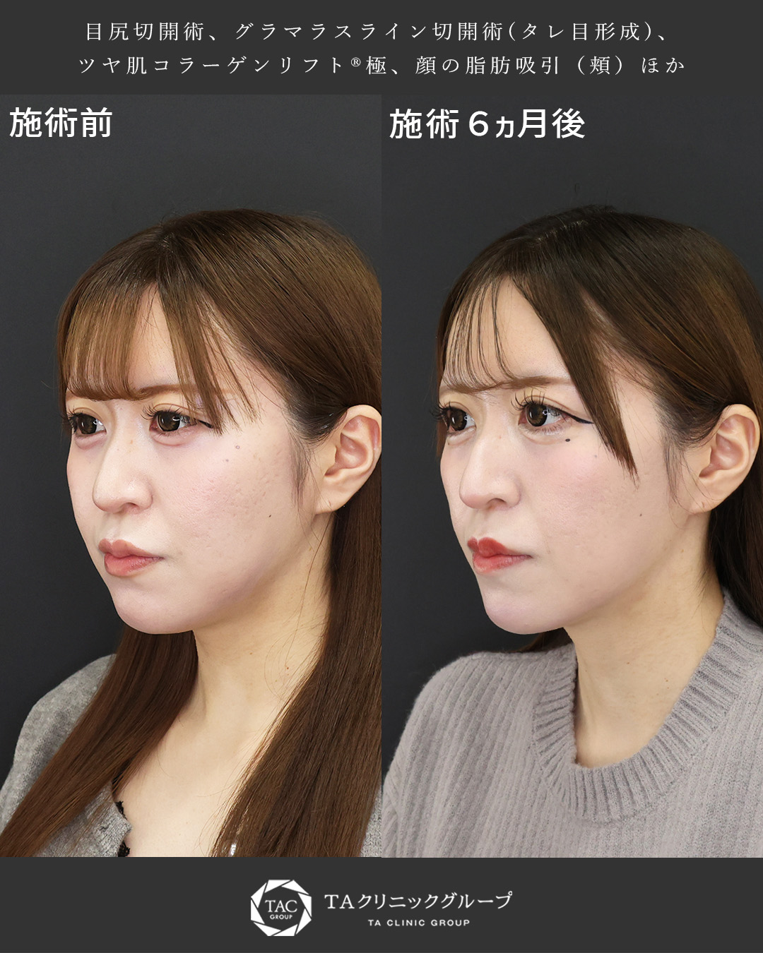 TAリフト/顎下の脂肪吸引・顔の脂肪吸引/Lラインファット除去（エラ下脂肪除去）の症例写真 施術前後 