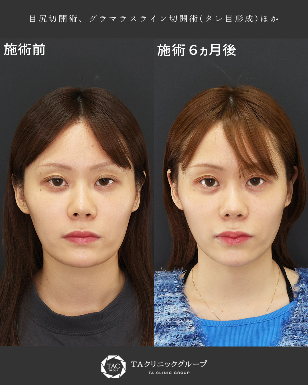 目尻切開術/グラマラスライン（タレ目形成）/涙袋形成（ヒアルロン酸注射）の症例写真 施術前後 