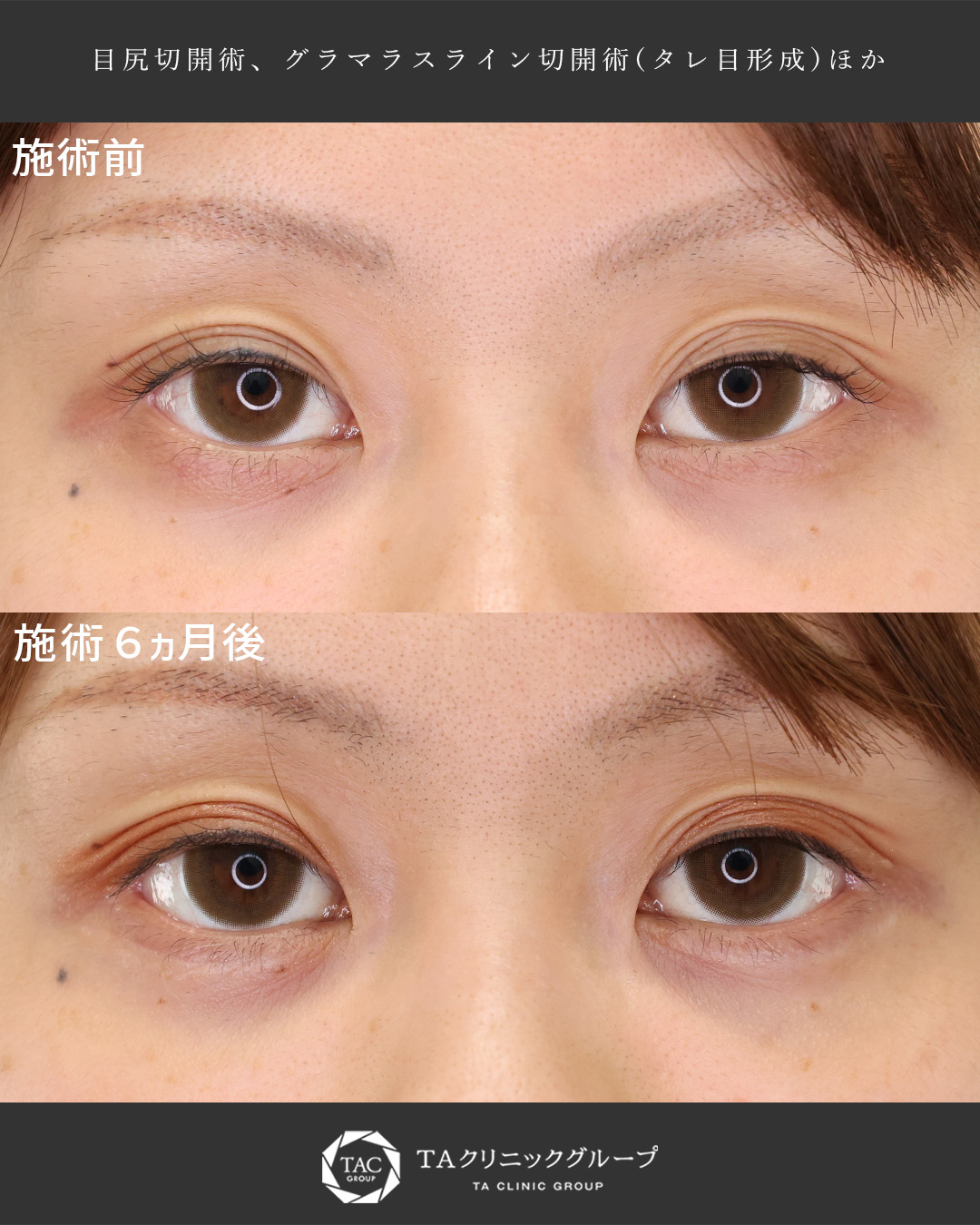 つり目の印象を改善◎│目尻切開術×グラマラスライン切開術(タレ目形成)