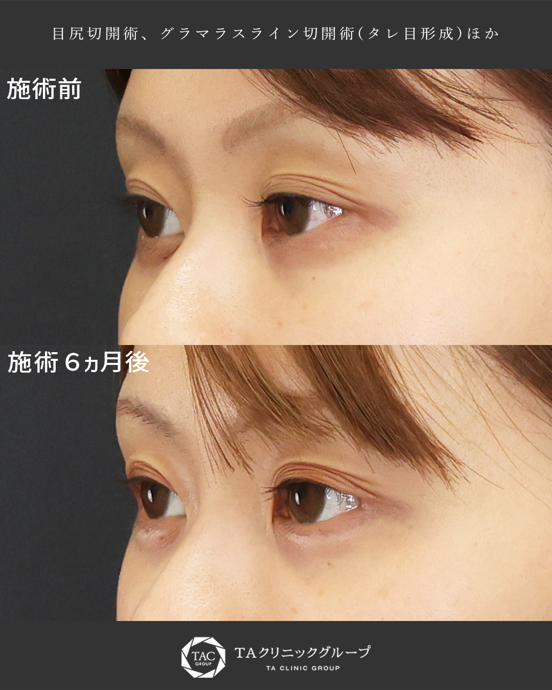 目尻切開術/グラマラスライン（タレ目形成）/涙袋形成（ヒアルロン酸注射）の症例写真 施術前後 