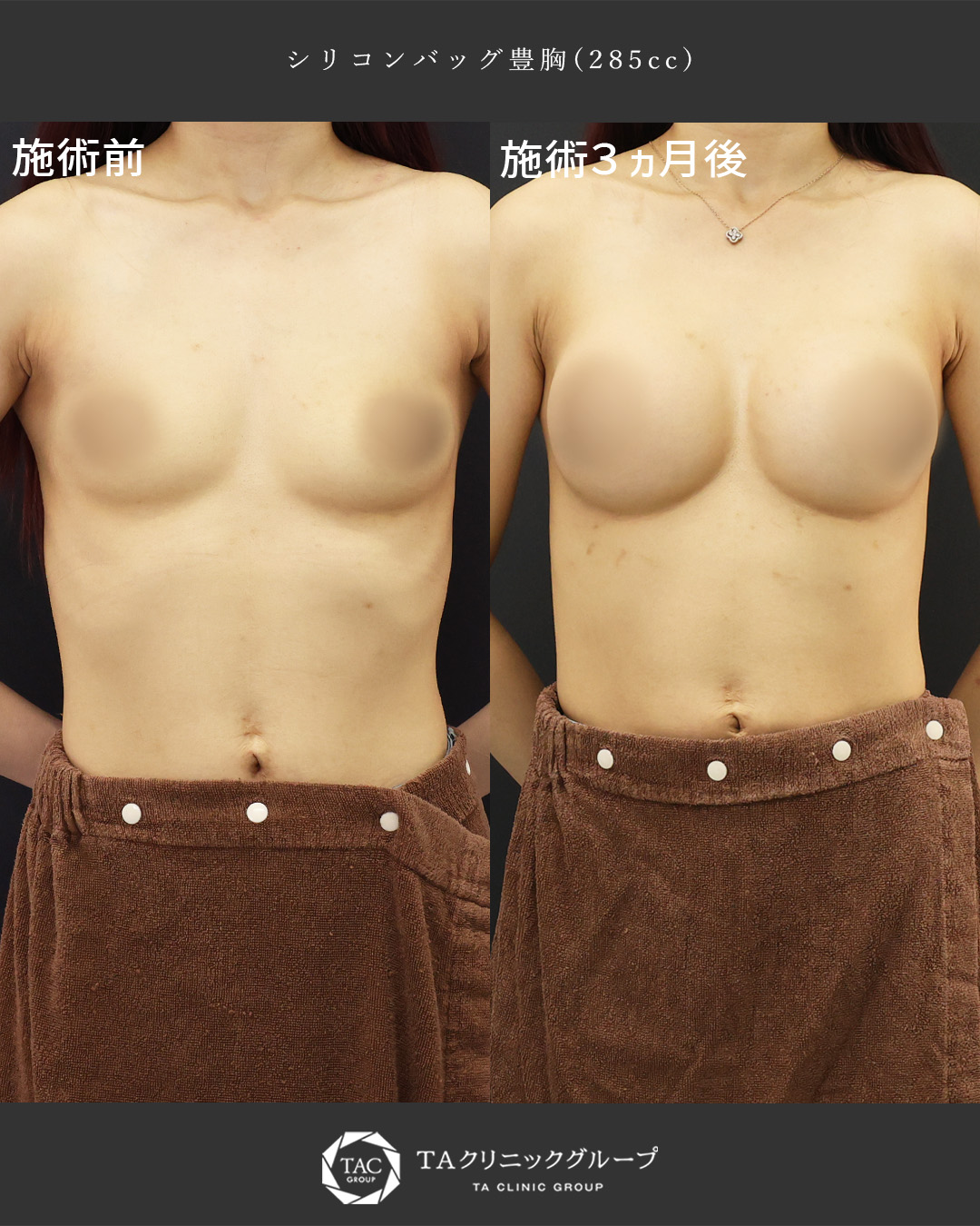 シリコンバッグ豊胸（人工乳腺バッグ）の症例写真 施術前後 