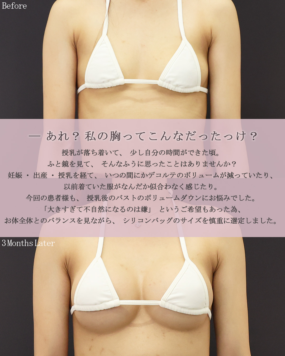 シリコンバッグ豊胸（人工乳腺バッグ）の症例写真 施術前後 
