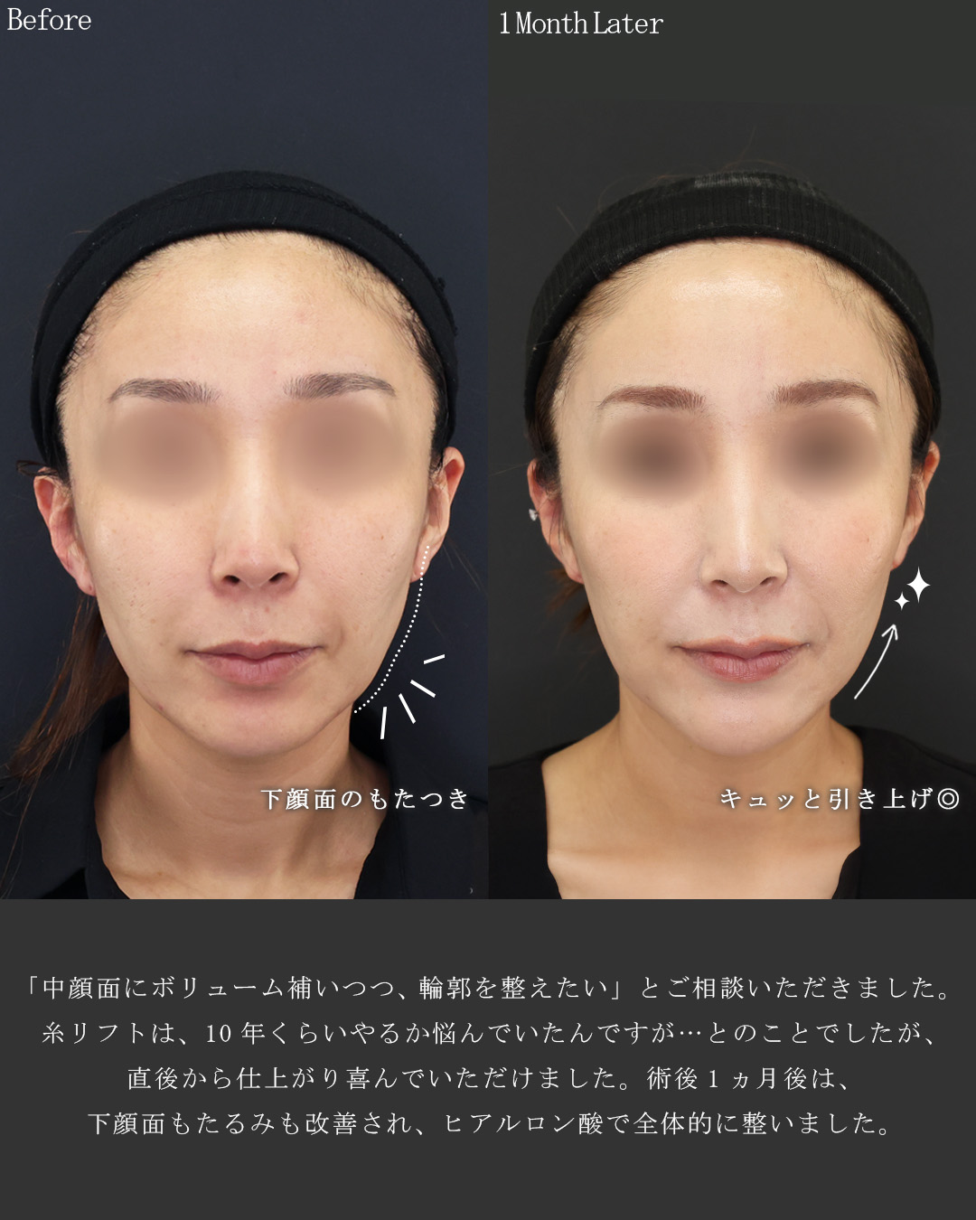 TAC式 ツヤ肌コラーゲンリフト®/ヒアルロン酸注射：その他の症例写真 施術前後 