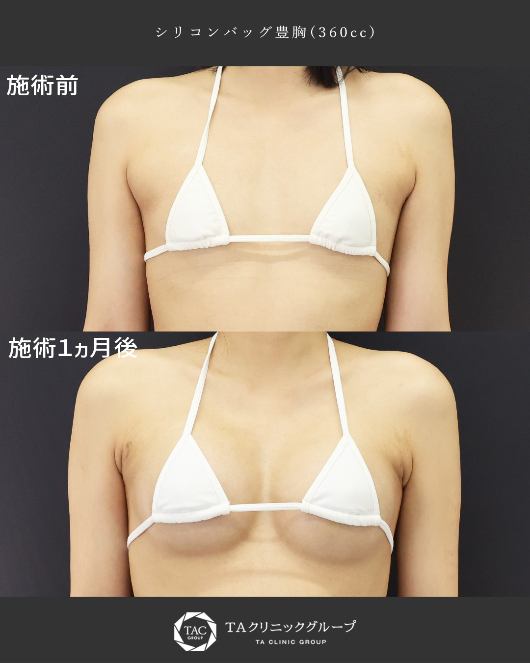 シリコンバッグ豊胸（人工乳腺バッグ）の症例写真 施術前後 