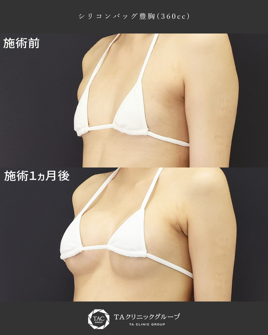 より理想に近づく◎│シリコンバッグ豊胸