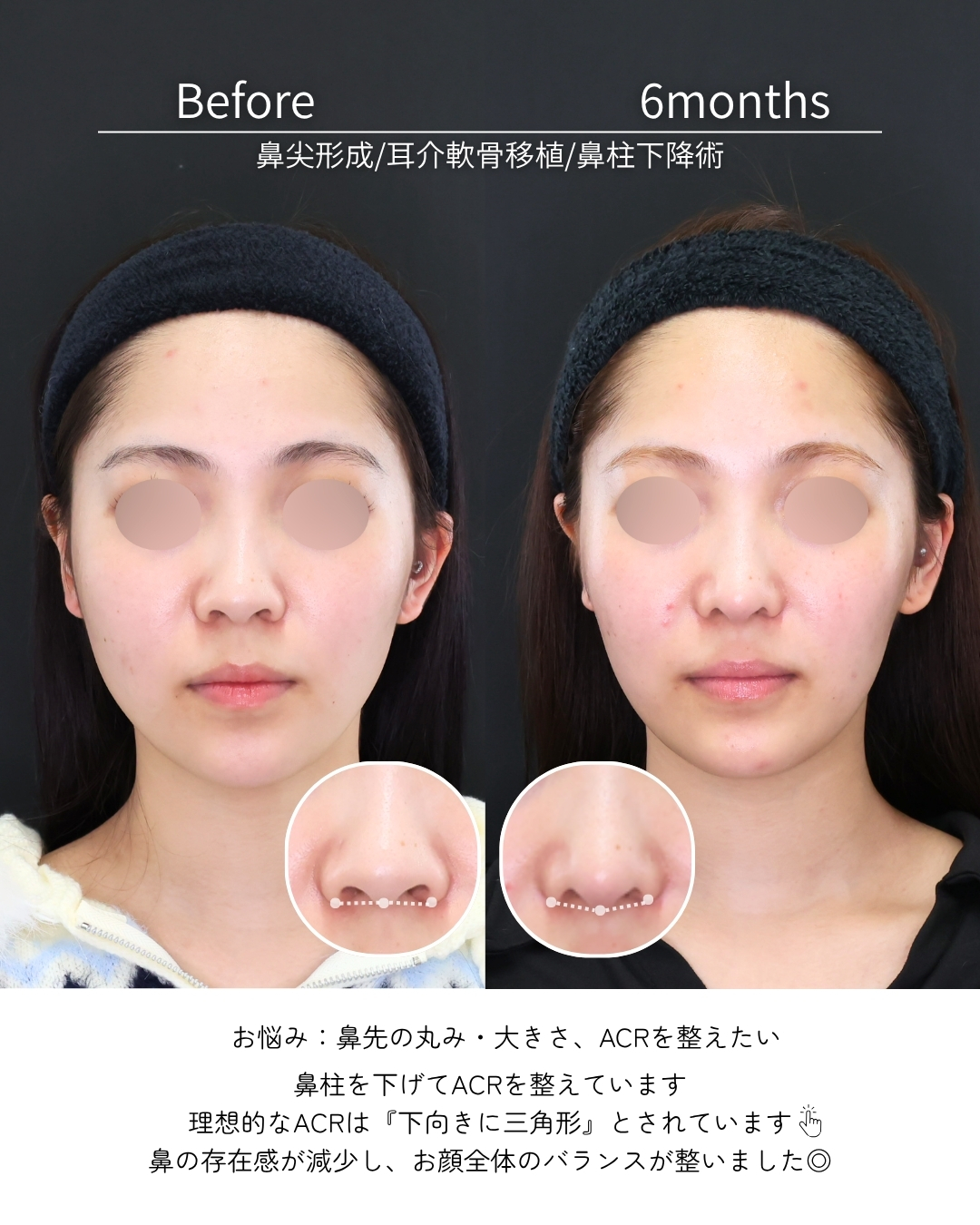 鼻尖形成・鼻尖縮小/鼻先軟骨移植/鼻唇角形成術・猫手術の症例写真 施術前後 
