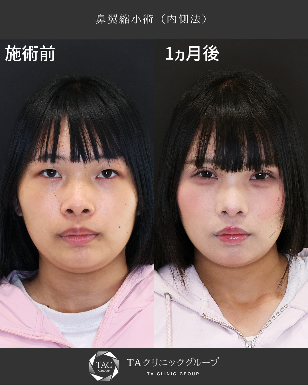 【鼻翼縮小術】小鼻の広がりを改善！理想の小鼻に