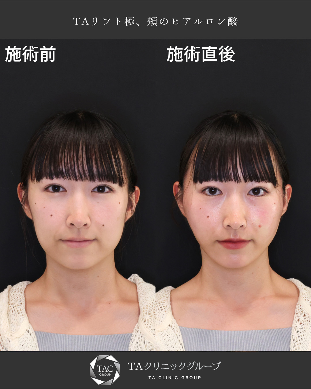 【TAリフト】施術直後からこの仕上がり！Dr.もりもりの糸リフト