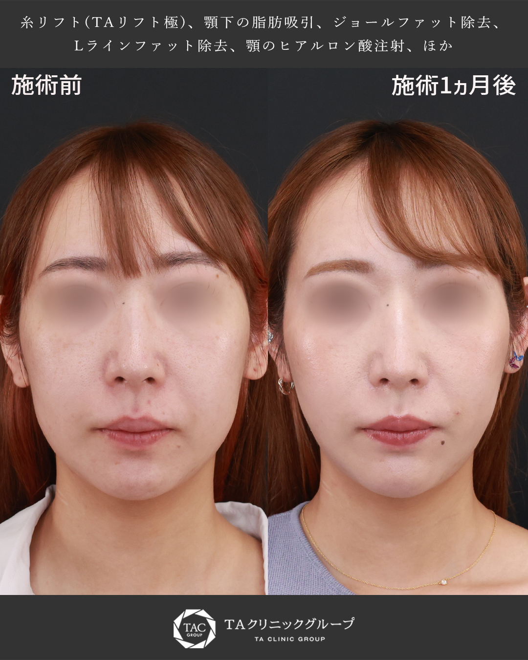 【糸リフト×脂肪吸引】もたつきを解消して卵型の輪郭に