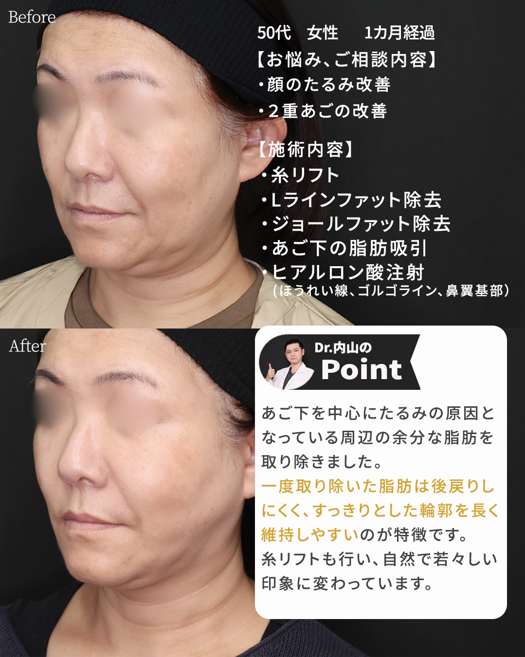 TAC式 ツヤ肌コラーゲンリフト®/Lラインファット除去（エラ下脂肪除去）/顎下の脂肪吸引・顔の脂肪吸引の症例写真 施術前後 