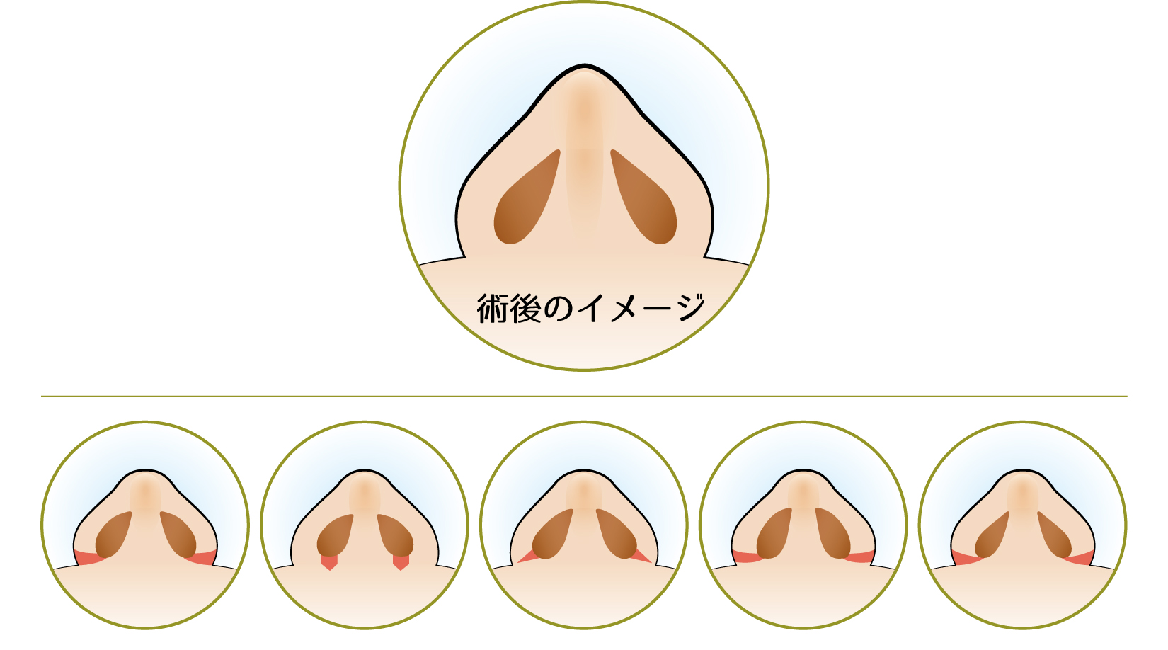 鼻翼縮小・小鼻縮小での理想の鼻の形の想定方法