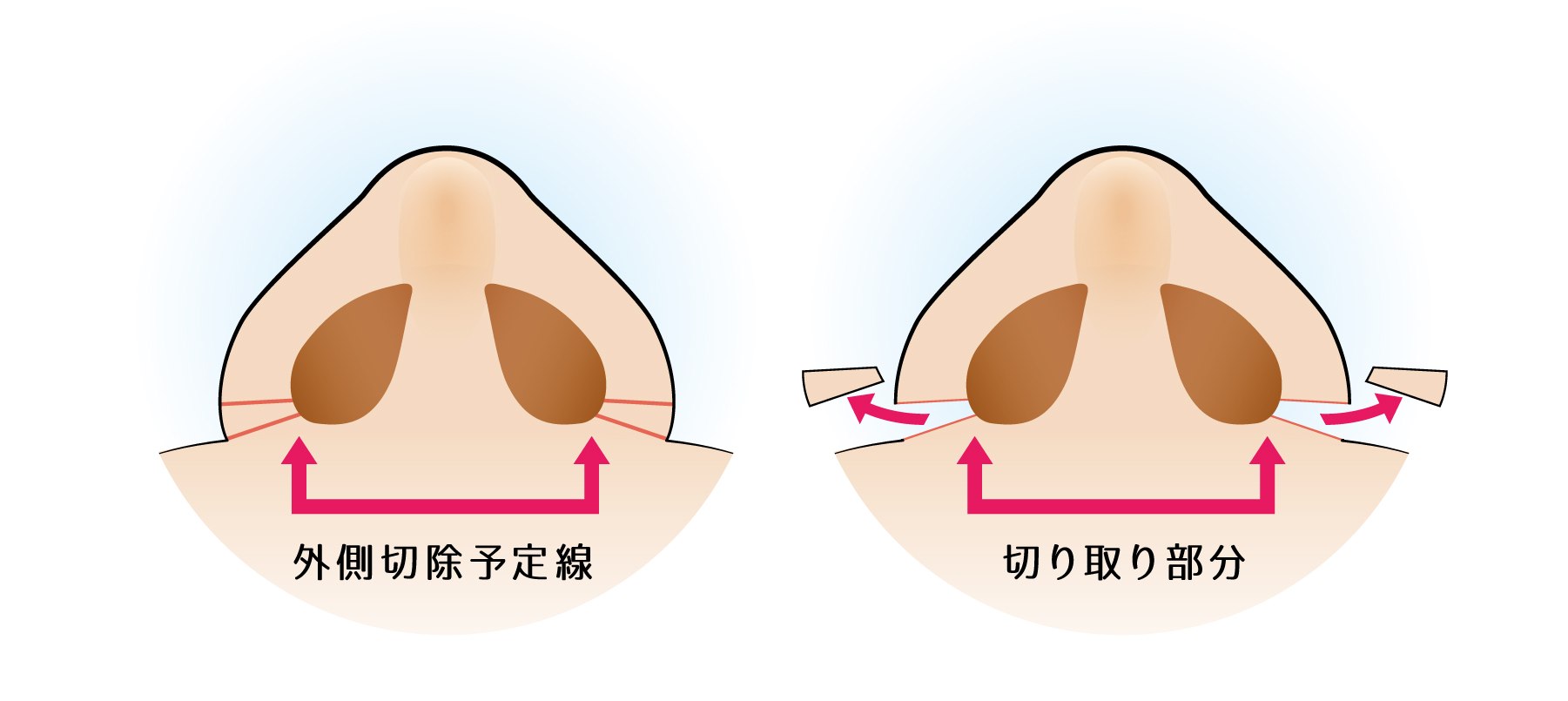 鼻翼縮小・小鼻縮小の内側法＋外側法とは