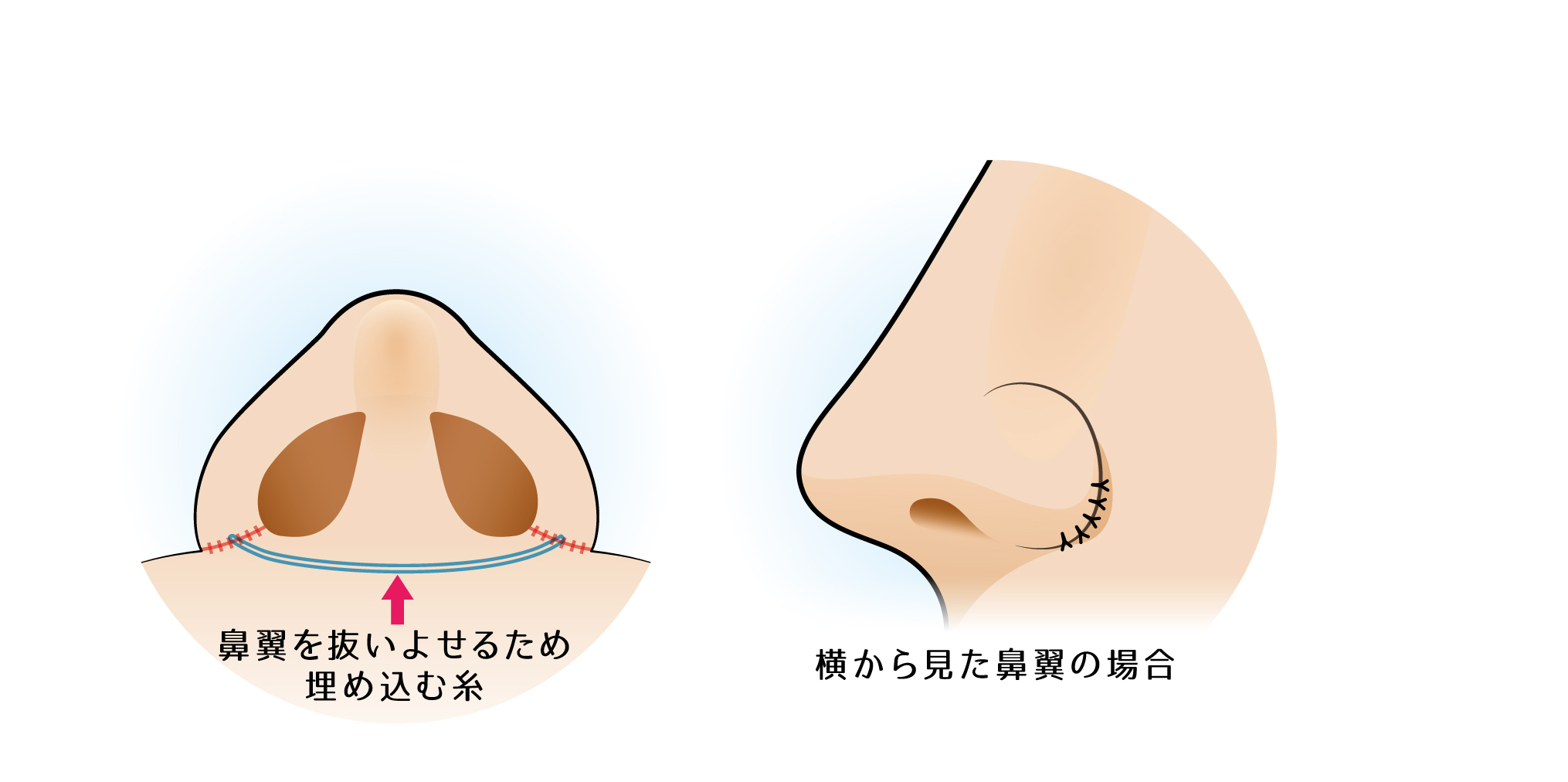 鼻翼縮小・小鼻縮小の内側法＋外側法とは