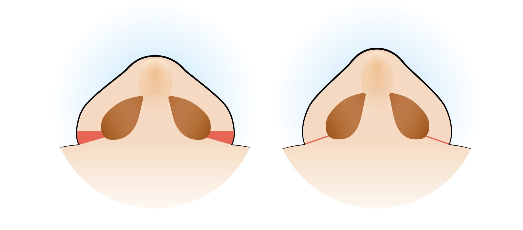 鼻翼縮小・小鼻縮小の外側法