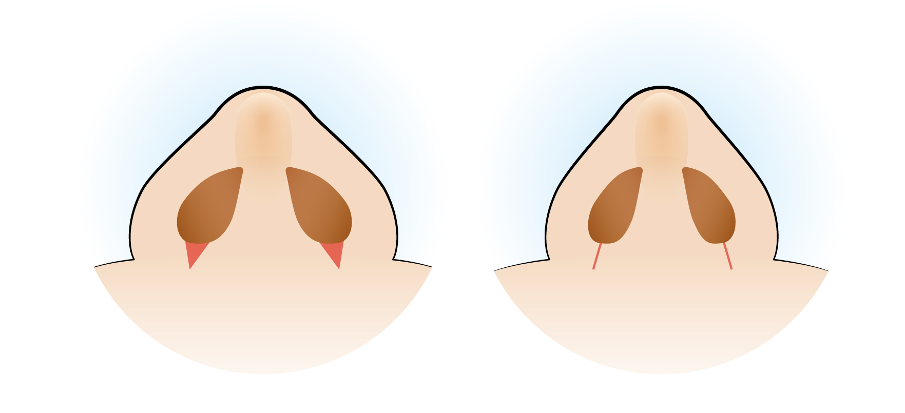 鼻翼縮小・小鼻縮小の内側法