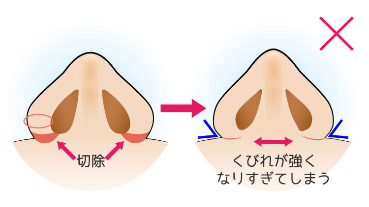 鼻翼の肉の厚みが厚い方（内側法＋外側法）